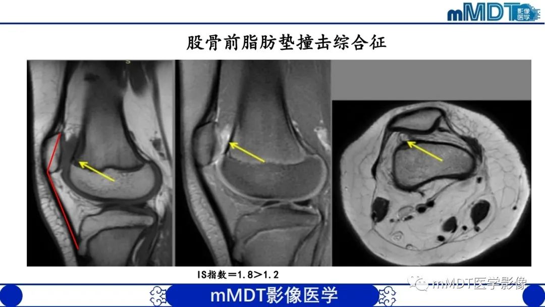 影像PPT - 【PPT】非肿瘤性前膝疼痛综合征MR评估—基于解剖层次视角-34 影像PPT - 【PPT】非肿瘤性前膝疼痛综合征MR评估—基于解剖层次视角-34
