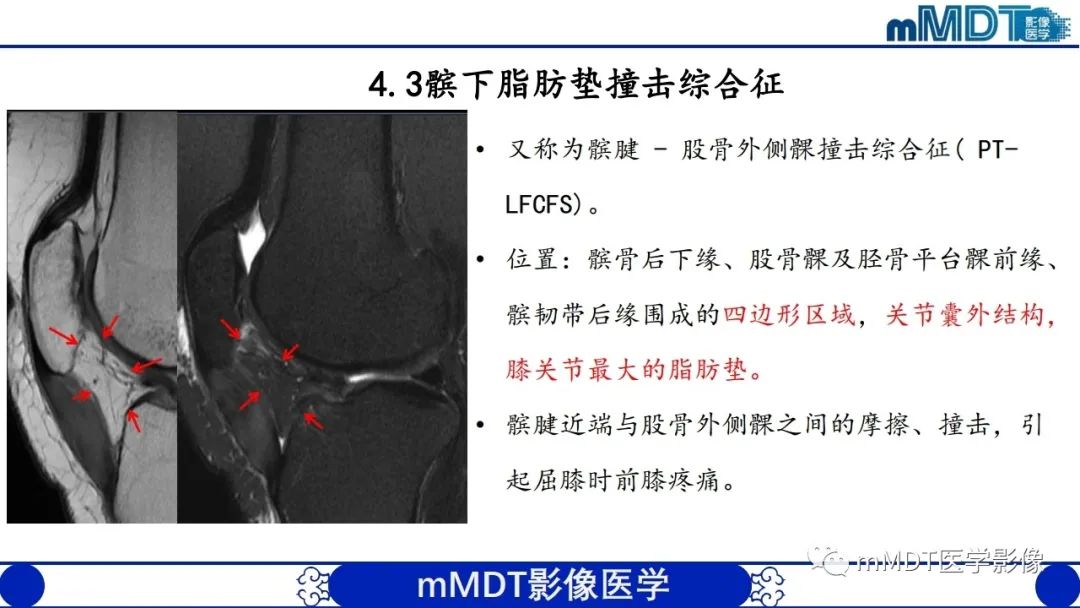 影像PPT - 【PPT】非肿瘤性前膝疼痛综合征MR评估—基于解剖层次视角-35 影像PPT - 【PPT】非肿瘤性前膝疼痛综合征MR评估—基于解剖层次视角-35