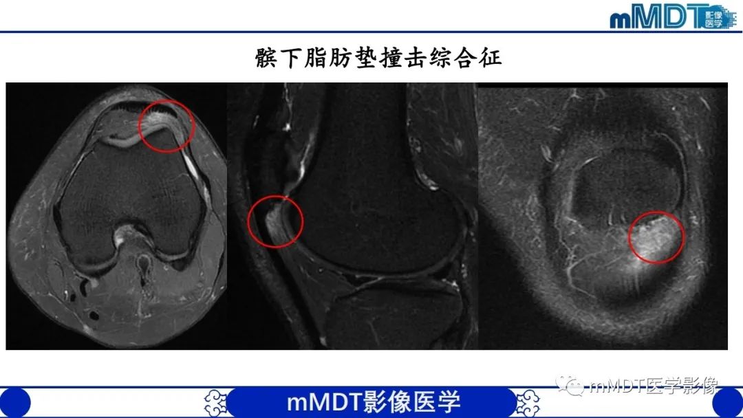 影像PPT - 【PPT】非肿瘤性前膝疼痛综合征MR评估—基于解剖层次视角-36 影像PPT - 【PPT】非肿瘤性前膝疼痛综合征MR评估—基于解剖层次视角-36