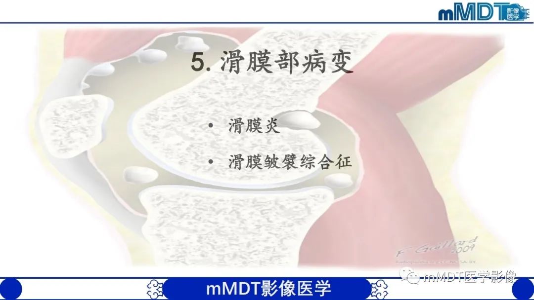 影像PPT - 【PPT】非肿瘤性前膝疼痛综合征MR评估—基于解剖层次视角-37 影像PPT - 【PPT】非肿瘤性前膝疼痛综合征MR评估—基于解剖层次视角-37