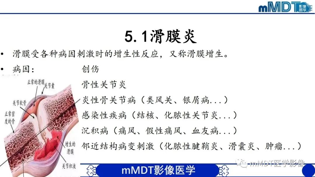 影像PPT - 【PPT】非肿瘤性前膝疼痛综合征MR评估—基于解剖层次视角-39 影像PPT - 【PPT】非肿瘤性前膝疼痛综合征MR评估—基于解剖层次视角-39