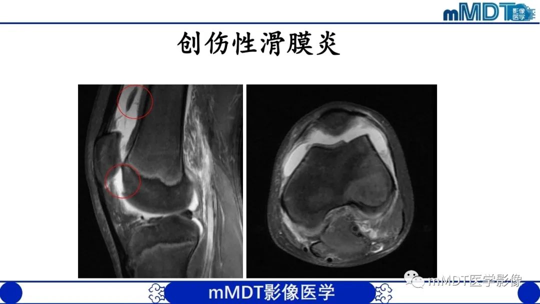 影像PPT - 【PPT】非肿瘤性前膝疼痛综合征MR评估—基于解剖层次视角-40 影像PPT - 【PPT】非肿瘤性前膝疼痛综合征MR评估—基于解剖层次视角-40