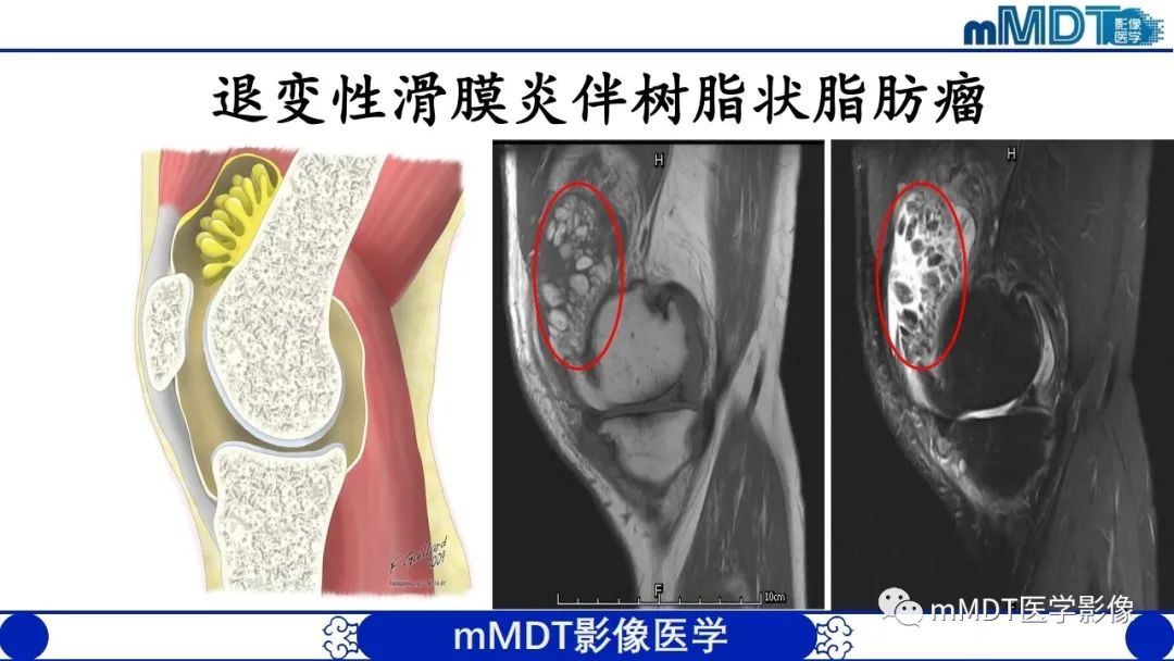 影像PPT - 【PPT】非肿瘤性前膝疼痛综合征MR评估—基于解剖层次视角-41 影像PPT - 【PPT】非肿瘤性前膝疼痛综合征MR评估—基于解剖层次视角-41