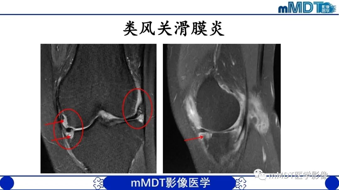 影像PPT - 【PPT】非肿瘤性前膝疼痛综合征MR评估—基于解剖层次视角-42 影像PPT - 【PPT】非肿瘤性前膝疼痛综合征MR评估—基于解剖层次视角-42