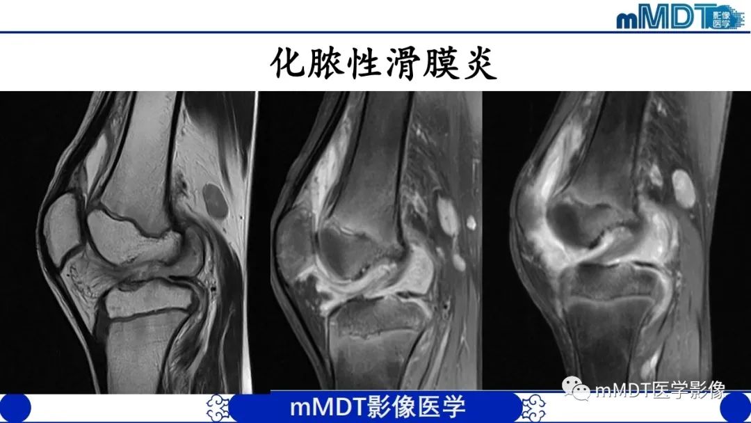 影像PPT - 【PPT】非肿瘤性前膝疼痛综合征MR评估—基于解剖层次视角-43 影像PPT - 【PPT】非肿瘤性前膝疼痛综合征MR评估—基于解剖层次视角-43