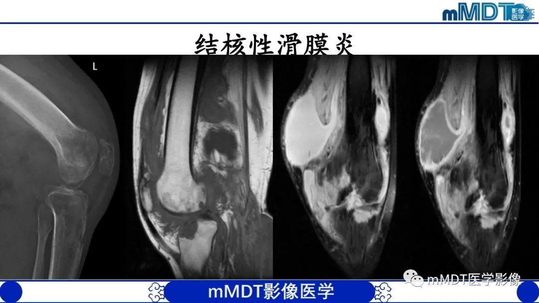 影像PPT - 【PPT】非肿瘤性前膝疼痛综合征MR评估—基于解剖层次视角-44 影像PPT - 【PPT】非肿瘤性前膝疼痛综合征MR评估—基于解剖层次视角-44