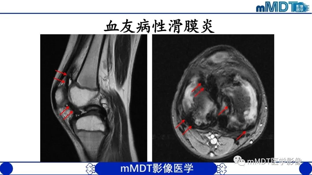 影像PPT - 【PPT】非肿瘤性前膝疼痛综合征MR评估—基于解剖层次视角-46 影像PPT - 【PPT】非肿瘤性前膝疼痛综合征MR评估—基于解剖层次视角-46