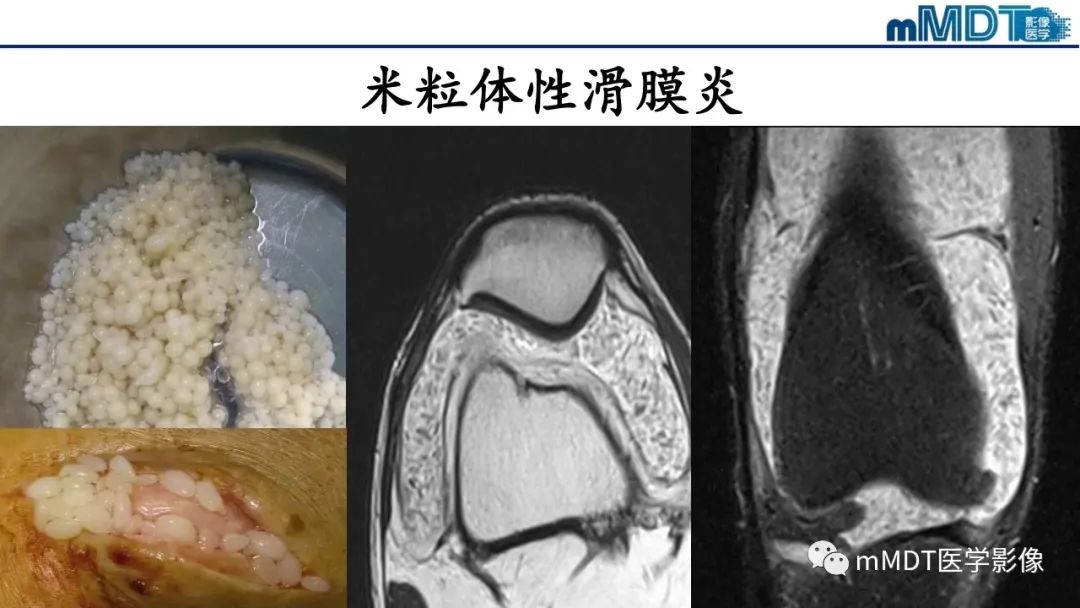 影像PPT - 【PPT】非肿瘤性前膝疼痛综合征MR评估—基于解剖层次视角-45 影像PPT - 【PPT】非肿瘤性前膝疼痛综合征MR评估—基于解剖层次视角-45
