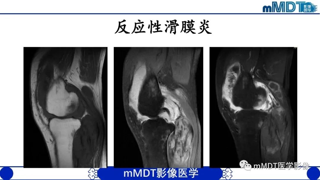 影像PPT - 【PPT】非肿瘤性前膝疼痛综合征MR评估—基于解剖层次视角-47 影像PPT - 【PPT】非肿瘤性前膝疼痛综合征MR评估—基于解剖层次视角-47