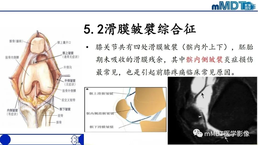 影像PPT - 【PPT】非肿瘤性前膝疼痛综合征MR评估—基于解剖层次视角-48 影像PPT - 【PPT】非肿瘤性前膝疼痛综合征MR评估—基于解剖层次视角-48