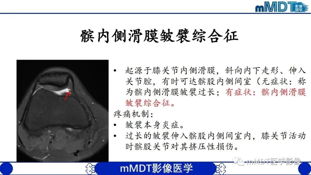 影像PPT - 【PPT】非肿瘤性前膝疼痛综合征MR评估—基于解剖层次视角-49 影像PPT - 【PPT】非肿瘤性前膝疼痛综合征MR评估—基于解剖层次视角-49