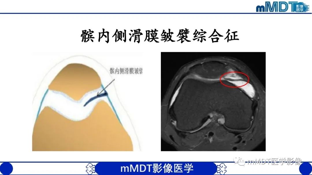 影像PPT - 【PPT】非肿瘤性前膝疼痛综合征MR评估—基于解剖层次视角-50 影像PPT - 【PPT】非肿瘤性前膝疼痛综合征MR评估—基于解剖层次视角-50