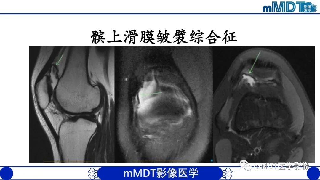 影像PPT - 【PPT】非肿瘤性前膝疼痛综合征MR评估—基于解剖层次视角-51 影像PPT - 【PPT】非肿瘤性前膝疼痛综合征MR评估—基于解剖层次视角-51