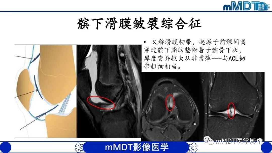 影像PPT - 【PPT】非肿瘤性前膝疼痛综合征MR评估—基于解剖层次视角-52 影像PPT - 【PPT】非肿瘤性前膝疼痛综合征MR评估—基于解剖层次视角-52