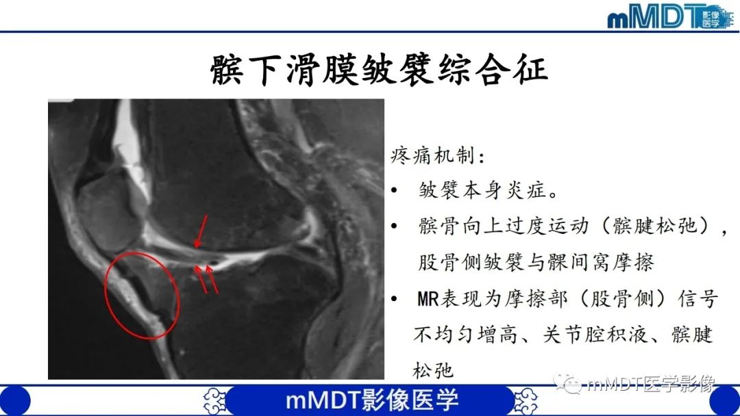影像PPT - 【PPT】非肿瘤性前膝疼痛综合征MR评估—基于解剖层次视角-53 影像PPT - 【PPT】非肿瘤性前膝疼痛综合征MR评估—基于解剖层次视角-53