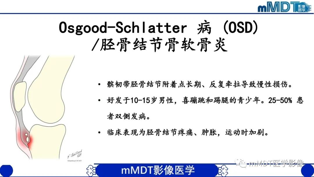 影像PPT - 【PPT】非肿瘤性前膝疼痛综合征MR评估—基于解剖层次视角-55 影像PPT - 【PPT】非肿瘤性前膝疼痛综合征MR评估—基于解剖层次视角-55