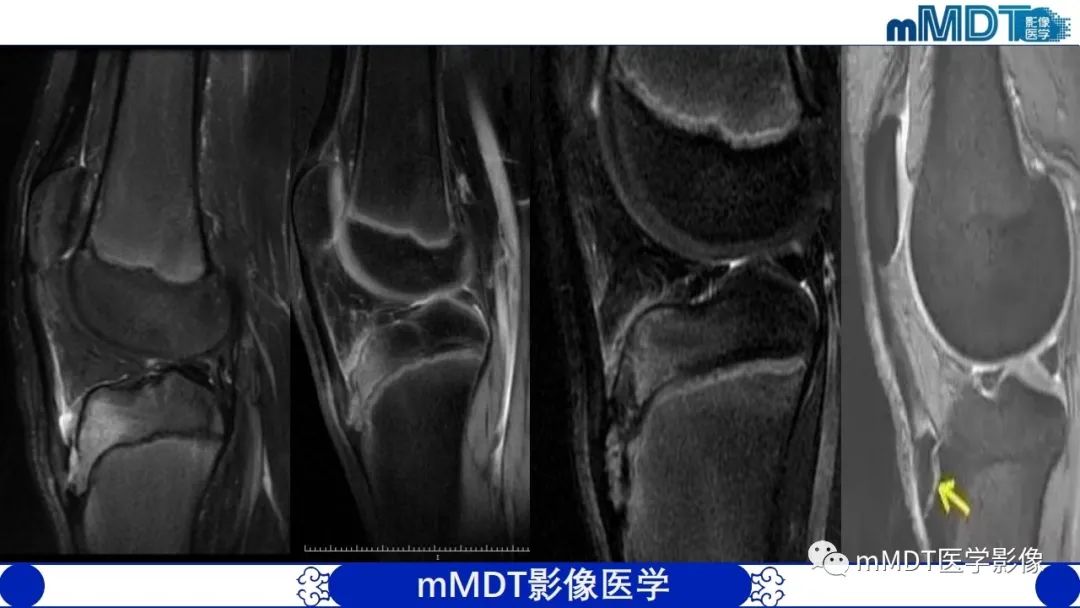 影像PPT - 【PPT】非肿瘤性前膝疼痛综合征MR评估—基于解剖层次视角-56 影像PPT - 【PPT】非肿瘤性前膝疼痛综合征MR评估—基于解剖层次视角-56