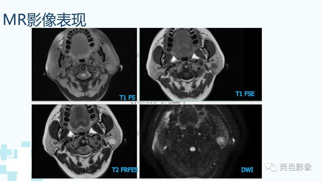 影像PPT - 【PPT】一例腮腺粘液囊肿病例分享-5