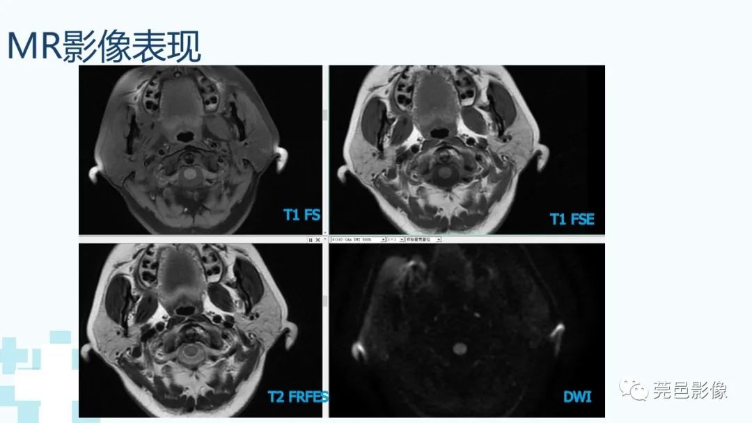 影像PPT - 【PPT】一例腮腺粘液囊肿病例分享-4