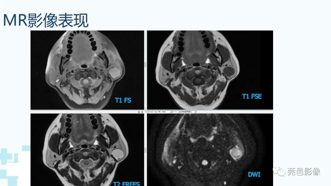 影像PPT - 【PPT】一例腮腺粘液囊肿病例分享-6