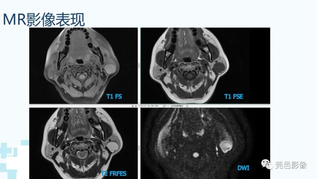 影像PPT - 【PPT】一例腮腺粘液囊肿病例分享-7