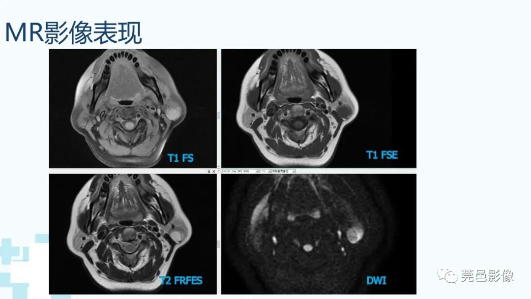 影像PPT - 【PPT】一例腮腺粘液囊肿病例分享-8