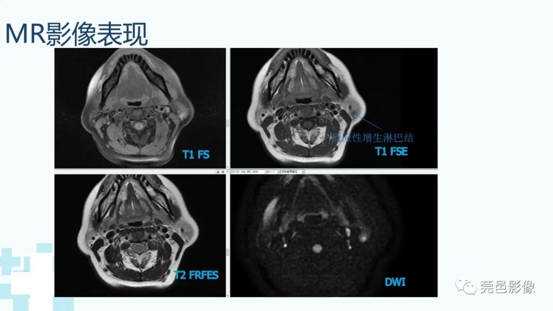 影像PPT - 【PPT】一例腮腺粘液囊肿病例分享-9