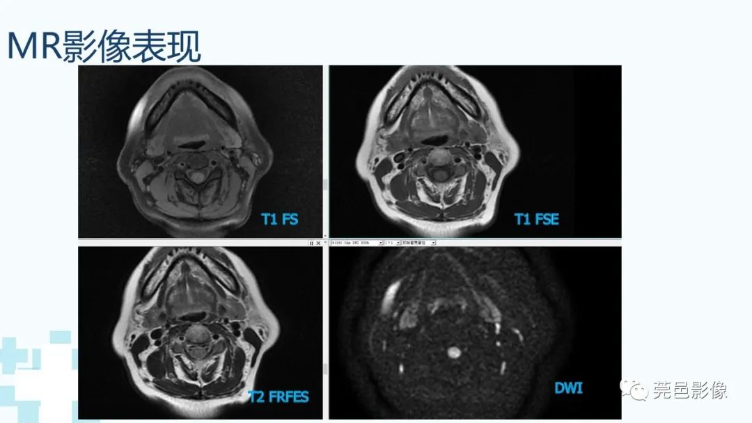 影像PPT - 【PPT】一例腮腺粘液囊肿病例分享-10