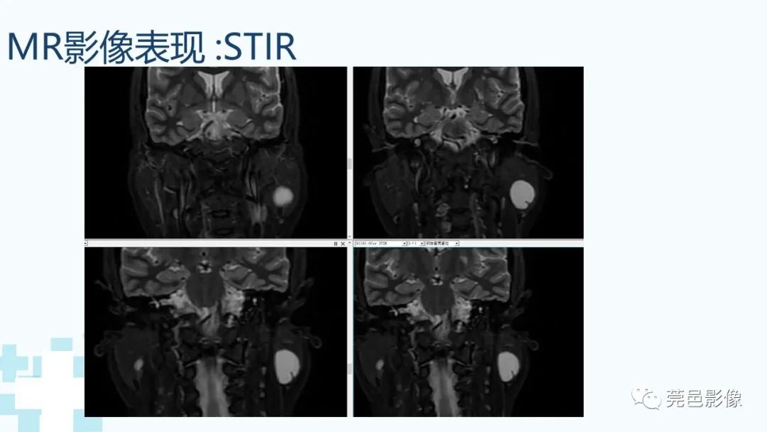 影像PPT - 【PPT】一例腮腺粘液囊肿病例分享-12