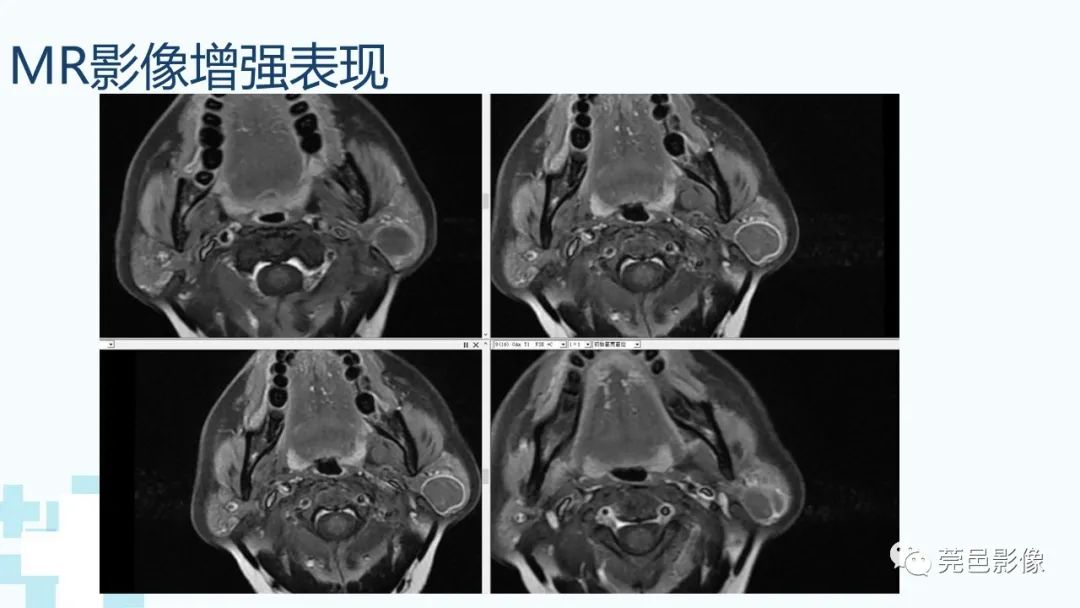 影像PPT - 【PPT】一例腮腺粘液囊肿病例分享-14