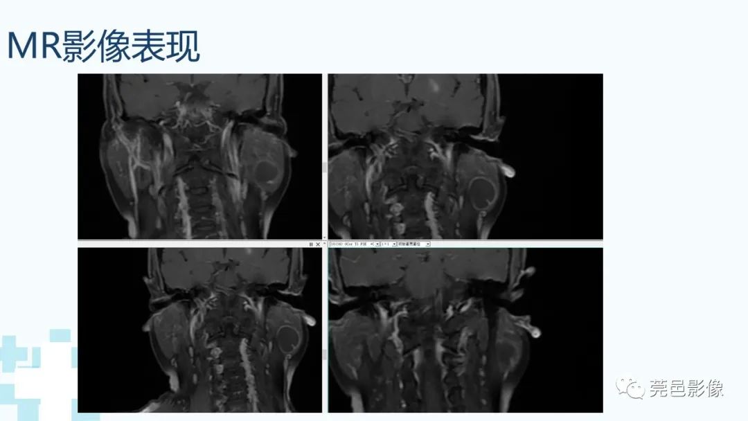 影像PPT - 【PPT】一例腮腺粘液囊肿病例分享-15