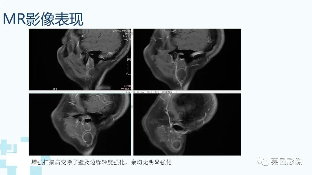 影像PPT - 【PPT】一例腮腺粘液囊肿病例分享-16