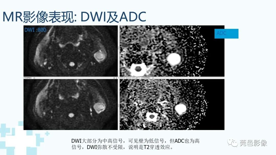 影像PPT - 【PPT】一例腮腺粘液囊肿病例分享-17