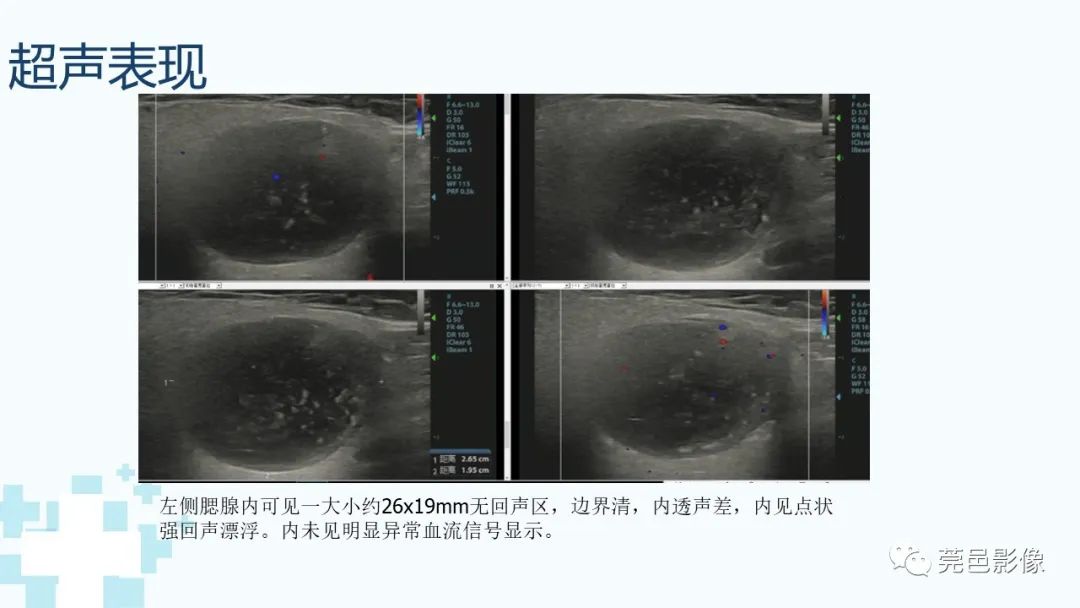影像PPT - 【PPT】一例腮腺粘液囊肿病例分享-18