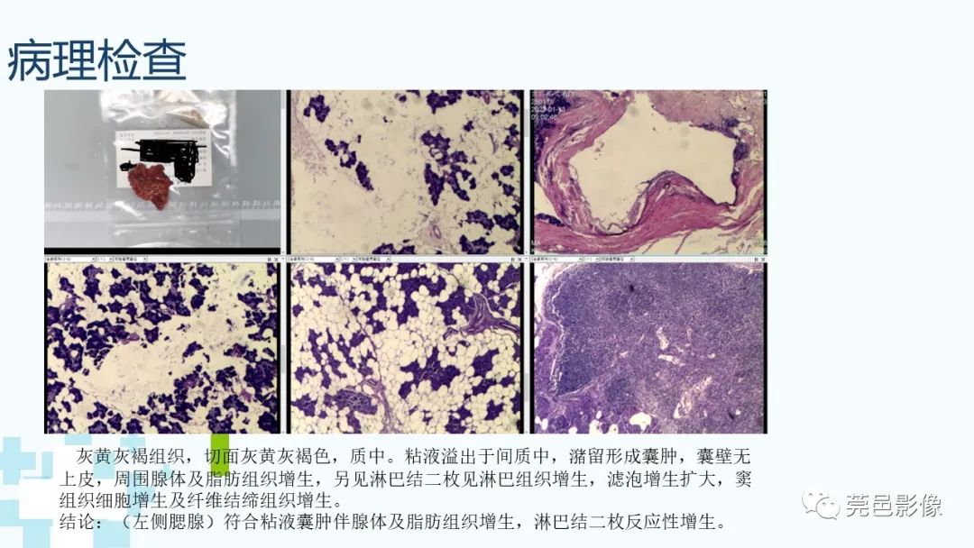 影像PPT - 【PPT】一例腮腺粘液囊肿病例分享-19