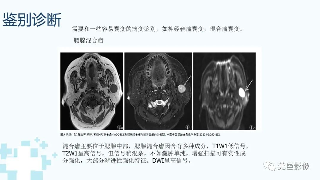 影像PPT - 【PPT】一例腮腺粘液囊肿病例分享-22