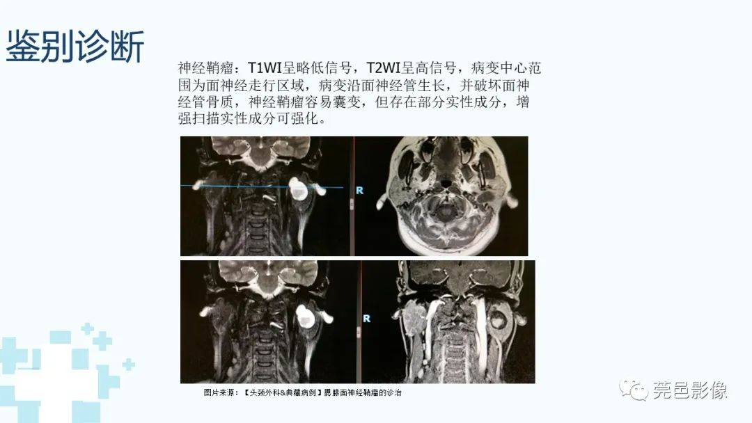 影像PPT - 【PPT】一例腮腺粘液囊肿病例分享-23
