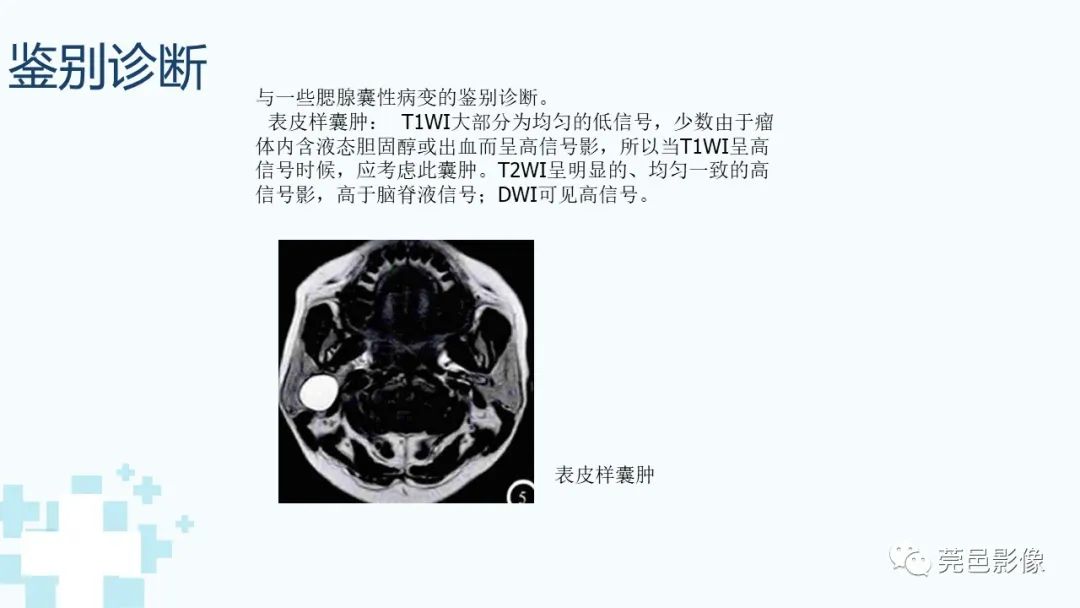 影像PPT - 【PPT】一例腮腺粘液囊肿病例分享-24