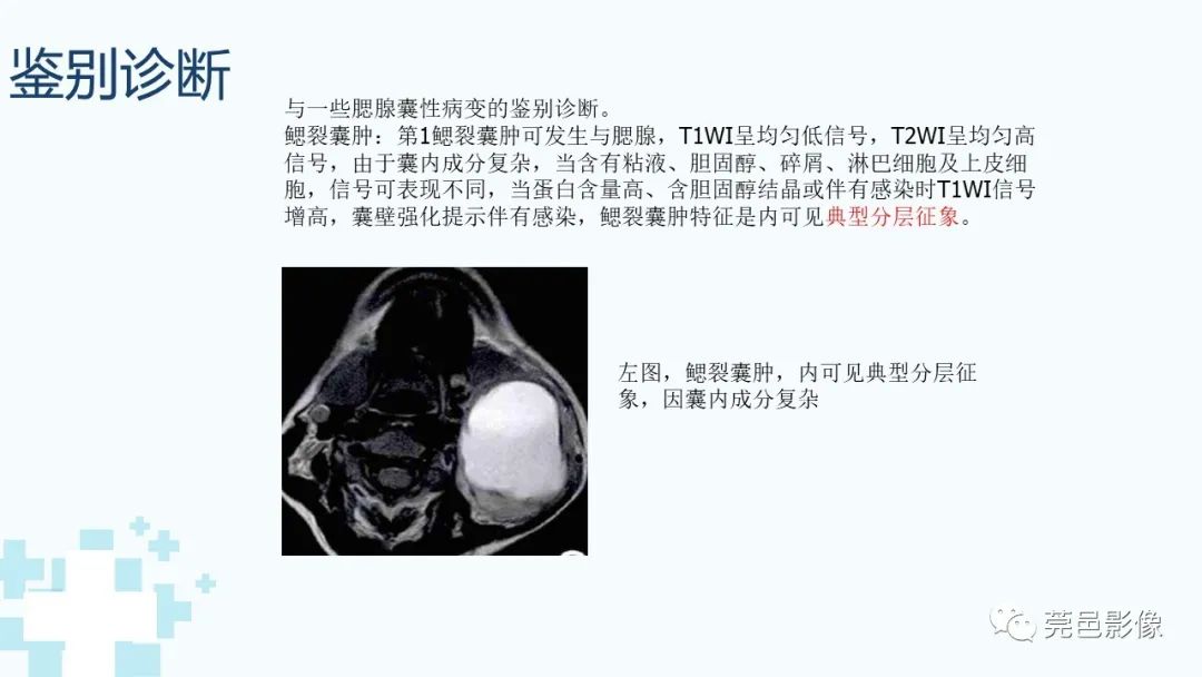 影像PPT - 【PPT】一例腮腺粘液囊肿病例分享-25