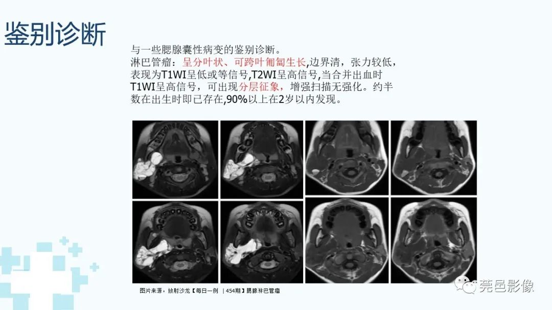 影像PPT - 【PPT】一例腮腺粘液囊肿病例分享-26