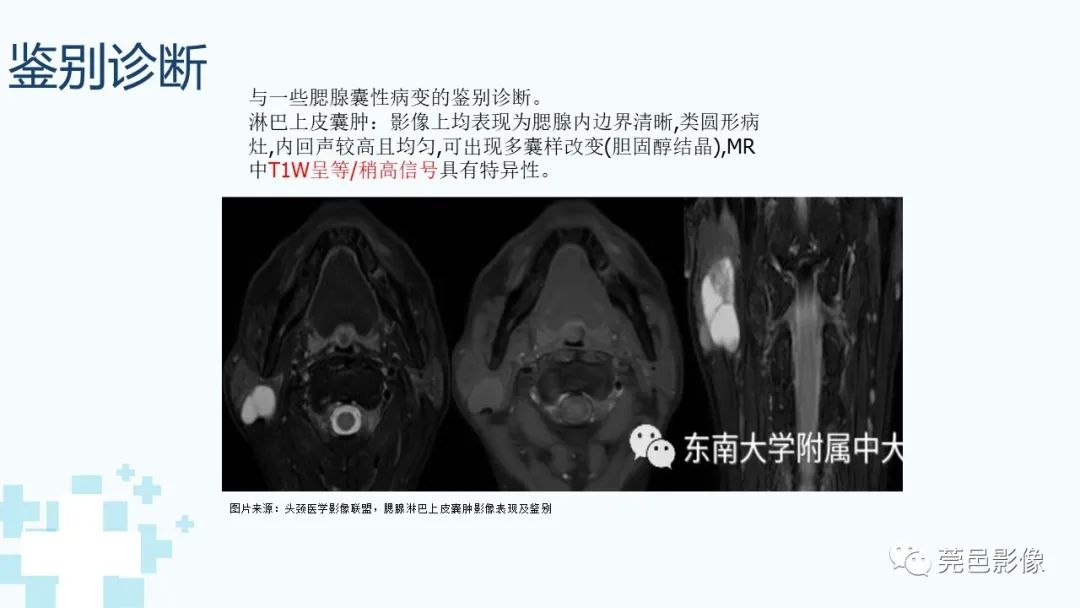 影像PPT - 【PPT】一例腮腺粘液囊肿病例分享-27