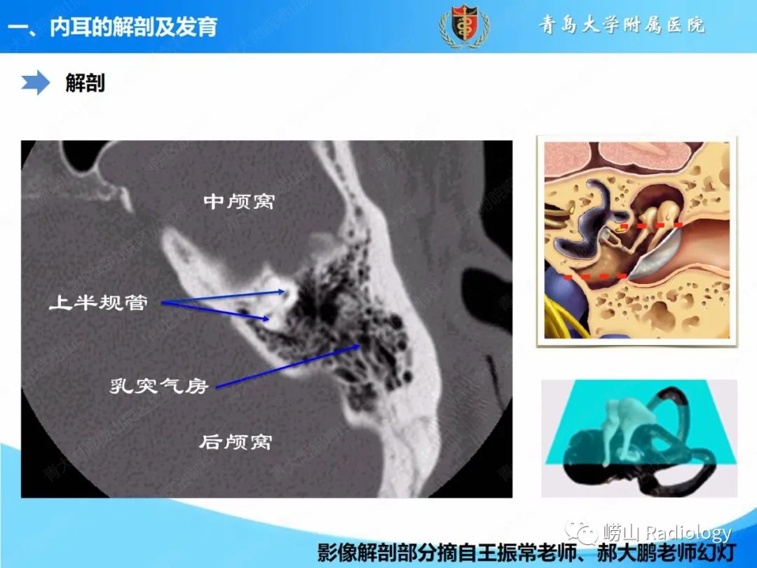 影像PPT - 【PPT】内耳畸形的影像学诊断-4