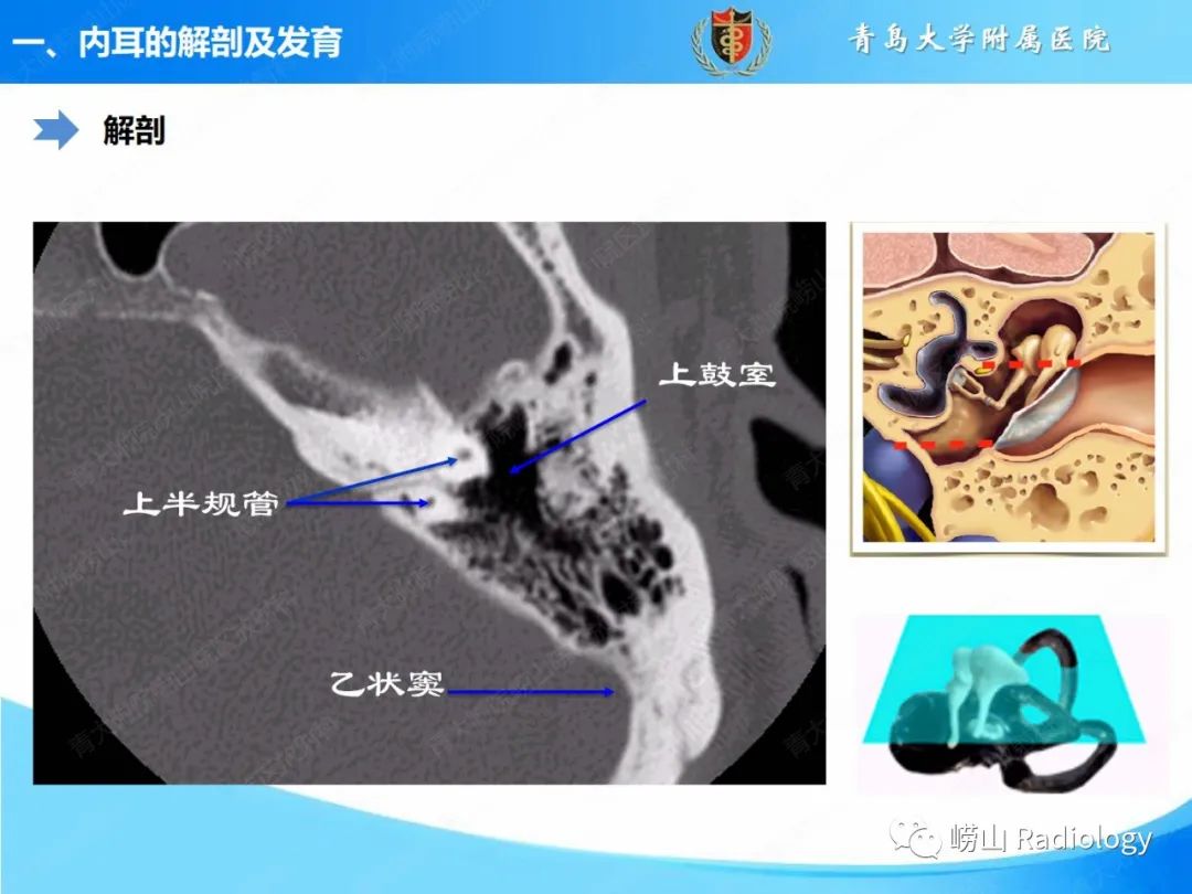影像PPT - 【PPT】内耳畸形的影像学诊断-5