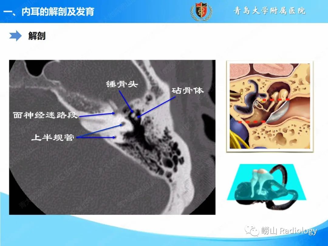 影像PPT - 【PPT】内耳畸形的影像学诊断-6