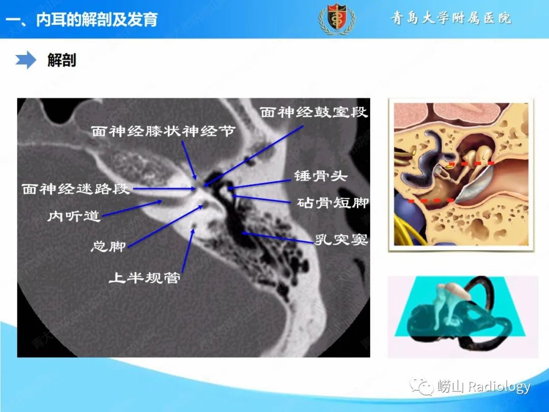 影像PPT - 【PPT】内耳畸形的影像学诊断-7