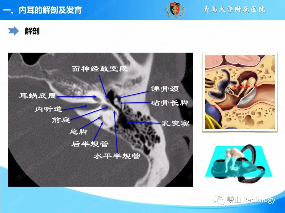 影像PPT - 【PPT】内耳畸形的影像学诊断-8