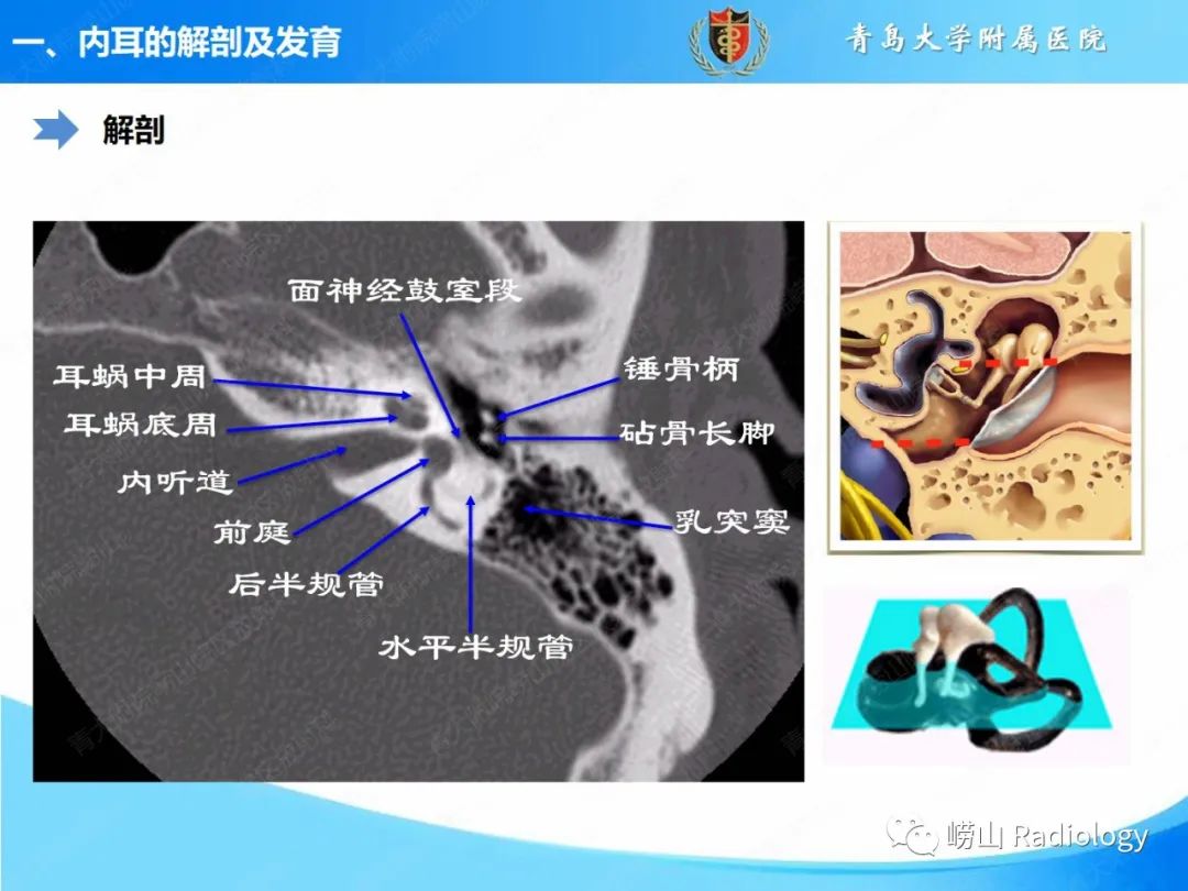 影像PPT - 【PPT】内耳畸形的影像学诊断-9