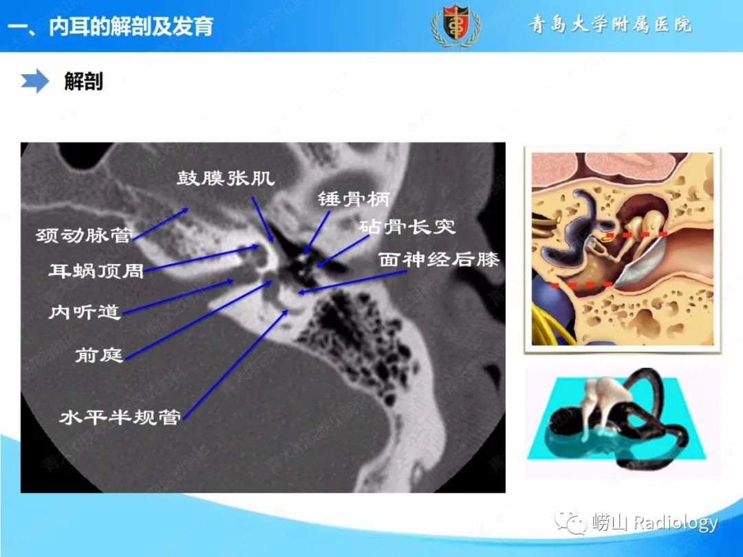影像PPT - 【PPT】内耳畸形的影像学诊断-10