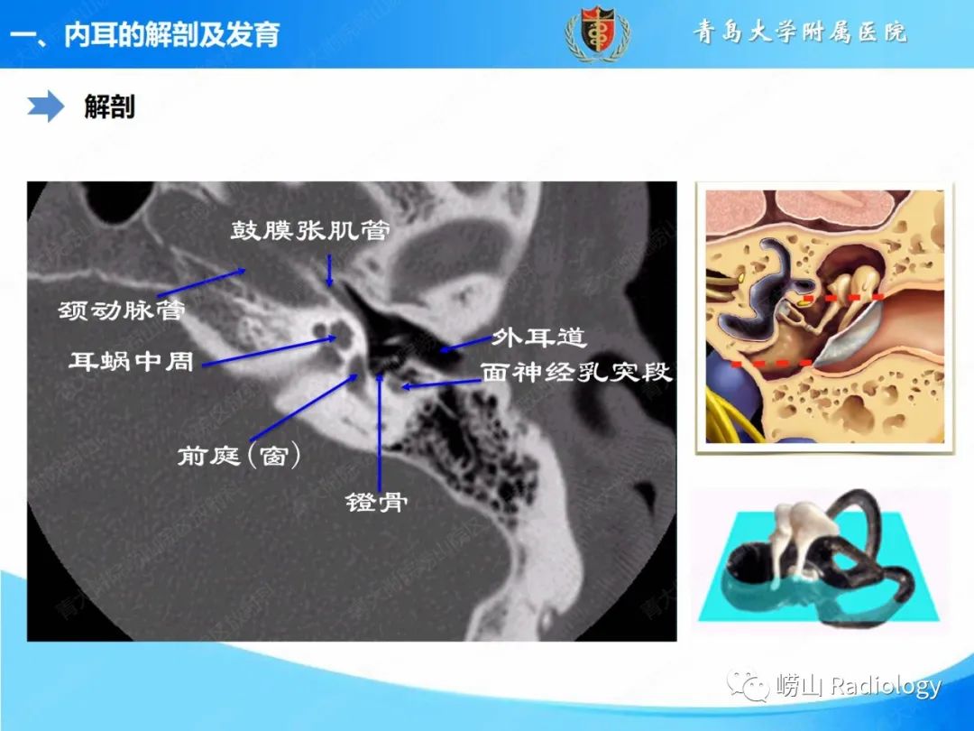 影像PPT - 【PPT】内耳畸形的影像学诊断-11