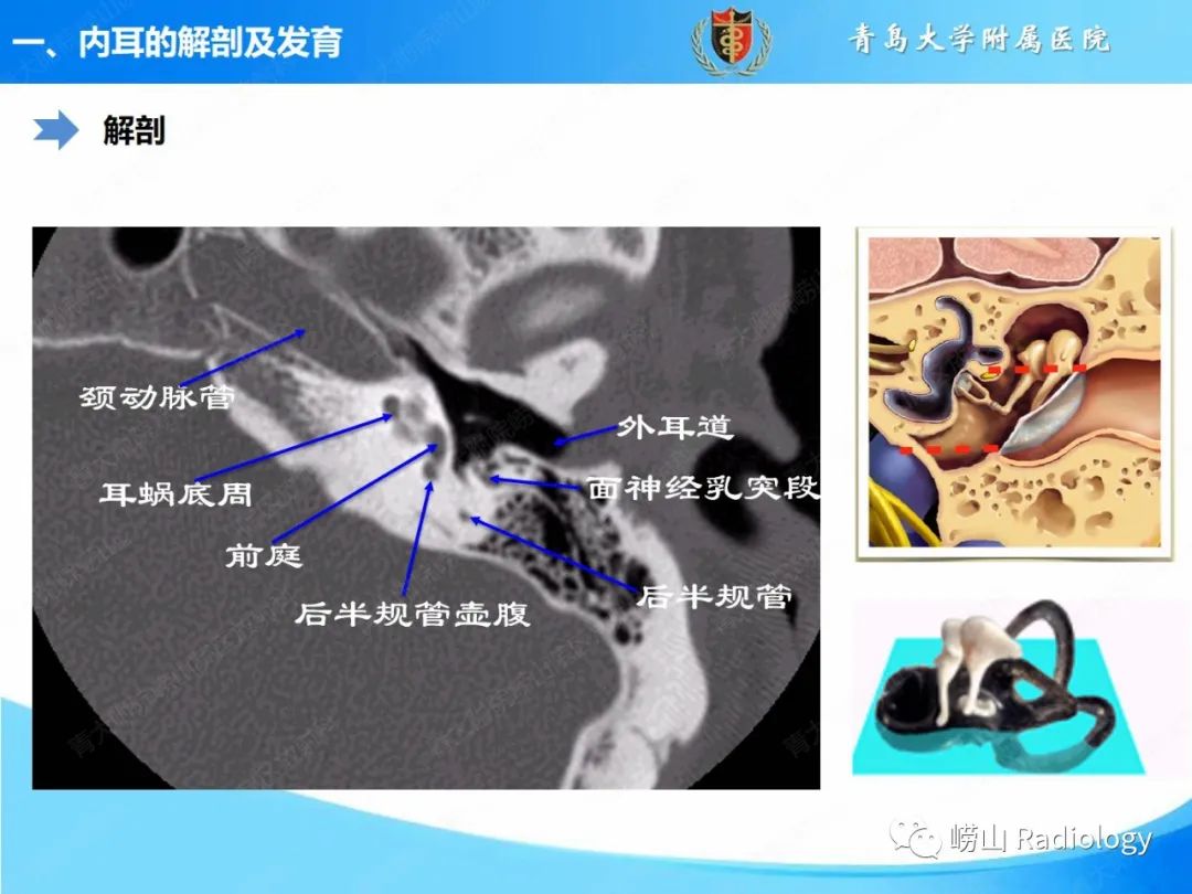 影像PPT - 【PPT】内耳畸形的影像学诊断-12